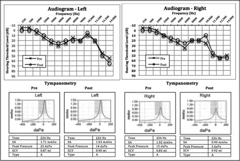 tympanometry graph interpretation|Common Types of Tympanograms .